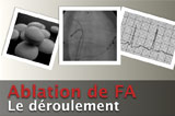 Ablation de FA : le déroulement