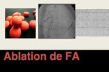 Ablation de FA : pourquoi ?