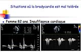 Prise en charge de la bradycardie chez l’insuffisant cardiaque. 