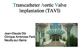 Valve aortique percutanée (TAVI)