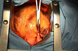 Pontages coronaires à coeur battant (OPCAB)