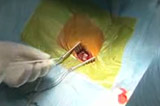 Implantation d'un stimulateur cardiaque