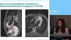 Traitement antithrombotique dans le TAVI. M. Akodad