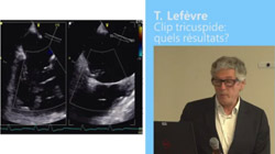Clip tricuspide : quels résultats ? T. Lefèvre