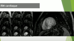 Amylose cardiaque. Dr Carma Karam