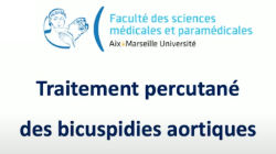 Traitement percutané des bicuspidies aortiques 