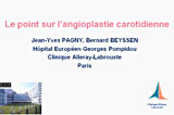 Le point sur l'angioplastie carotidienne