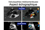 Valvulopathies médicamenteuses