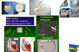 Traitement par assistance circulatoire:  le point de vue du cardiologue interventionnel   par Gilles Grollier