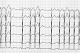 Session interactive de rythmologie : interprétation de tracés ECG