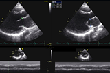 Myocardiopathies du peri-partum 