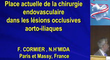 Place des revascularisations endovasculaires en cas de lsions proximales aorto-iliaques dans l'artriopathie des membres infrieurs