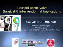 Implications chirurgicales, interventionnelles et scanographiques de la bicuspidie aortique 
